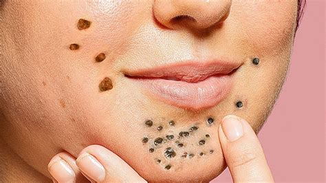 In the clip, which is nearly five minutes long, you can see just huge blackheads being pulled right from the. . Best nose blackhead removal videos 2021
